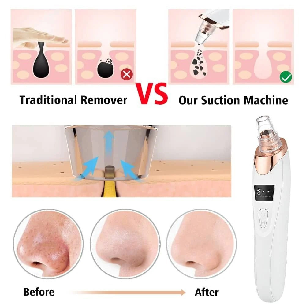 Electric Blackhead Remover Vacuum | Pore Cleaner & Acne Extractor with 5 Suction Heads | Facial Skin Care Tool
